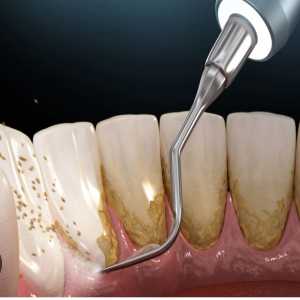 How Is Teeth Cleaning Done?