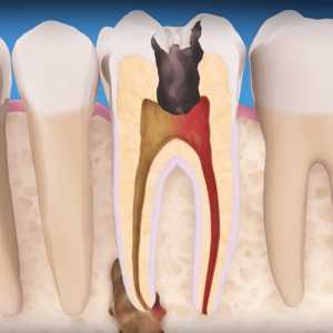 How To Prepare For Your Root Canal Treatment
