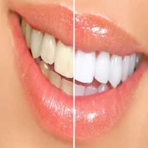 Illuminating Smiles: The Magic Of Teeth Whitening In Nizamabad