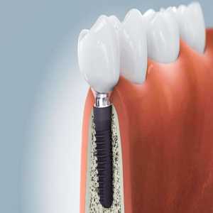 Implantologist In Navi Mumbai - Ivory Dental Clinic