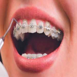 Important Tips When You Have Dental Braces Treatment
