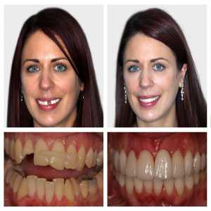 Missing Teeth? The Successful Tooth Replacement Options