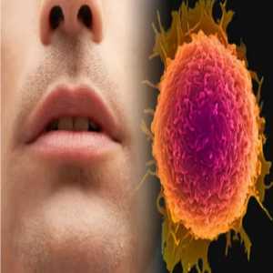Navigating Oral Cancer Treatment In Aurangabad: Finding The Right Doctors