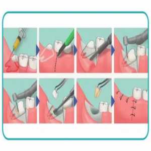 Navigating Wisdom Tooth Removal In Noida Sector 104: A Comprehensive Guide