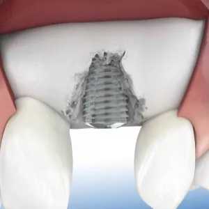 Newtown PA Periodontist: Why Dental Implants Are The Best Solution