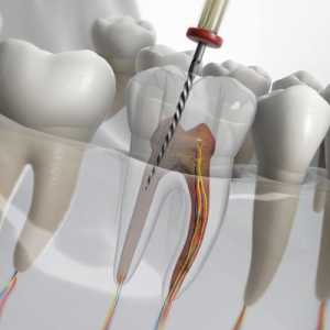 Pain-Free Teeth: Root Canal Treatment Options Available In Dombivli