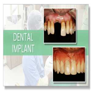 Painless Dental Implants Treatment Near You In Pune