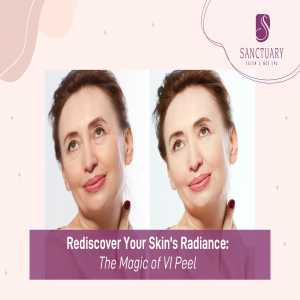 Rediscover Your Skin's Radiance: The Magic Of VI Peel