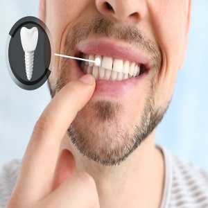 Revive Your Smile: Exploring Dental Implants In Rajajinagar