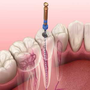 Root Canal Recovery: Tips For A Smooth Healing Process