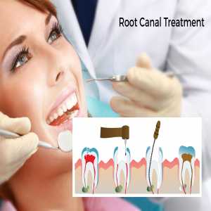 Root Canal Treatment And Dental Hygiene: Best Practices