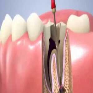 Root Canal Treatment In Aurangabad: A Comprehensive Guide