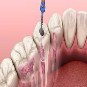 Root Canal Treatment: The Role Of Patient Education