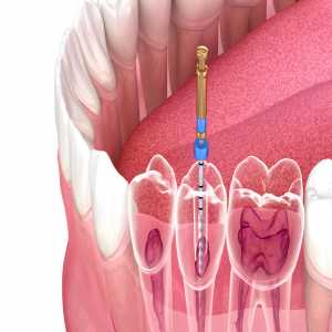 Root Canal Treatment: Understanding The Benefits