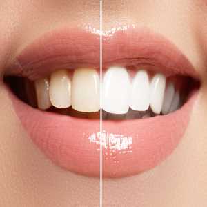 Say Goodbye To Stains: Unveiling Teeth Whitening Options In Nagpur