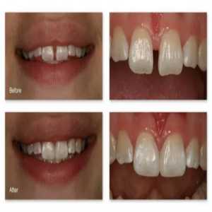 Smile Harmony: Unveiling The Artistry Of Teeth Gap Closing In Nerul