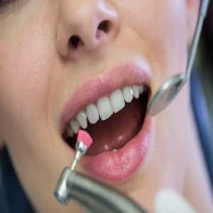 Steps Involved In Professional Dental Cleaning