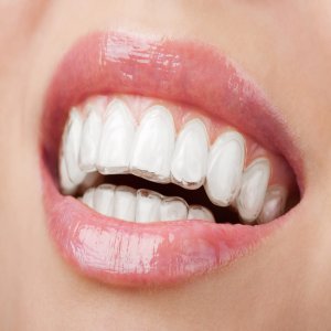 Straightening and Teeth Braces