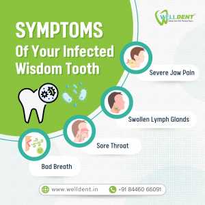 Symptoms Of Your Infected Wisdom Tooth