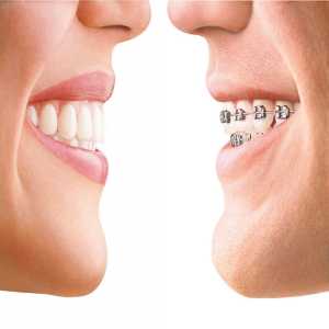 Teeth Braces: Traditional Vs. Invisalign – Which Is Best?