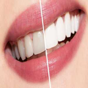 Teeth Whitening Treatment In East Delhi - Brightening Your Smile