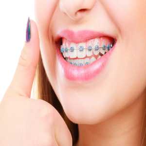 The Benefits Of Early Braces Treatment