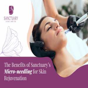 The Benefits Of Sanctuary’s Micro-needling For Skin Rejuvenation