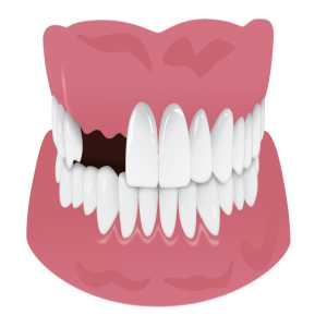 The Emotional And Psychological Benefits Of Replacing Missing Teeth