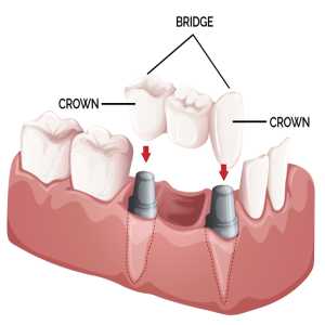 The Importance Of Bite Alignment In Crown And Bridge Treatments