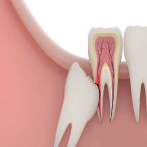 The Importance Of Follow-Up Appointments After Wisdom Teeth Removal