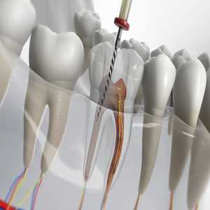 Toothache Got You Down? Exploring Root Canal Treatment Options In Nagpur