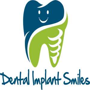 Top 5 Frequently Asked Questions About Dental Implants
