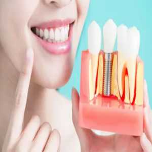 Understanding Dental Implant Cost In Madhapur: What To Expect