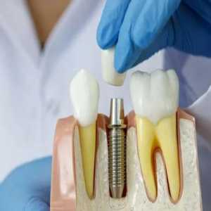 Understanding The Timeframe: How Long Does A Dental Implant Procedure Take?