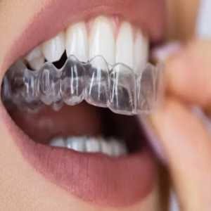 Unveiling The Beauty Of Invisible Braces Treatment In Dattawadi Pune