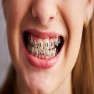 Unveiling The Investment: Braces Treatment Cost In Aurangabad