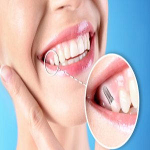 Unveiling Transparency: Demystifying Dental Implant Cost In Deonar Chembur