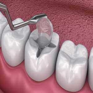 What Is The Best Cosmetic Treatment For Teeth?