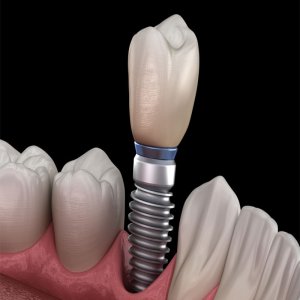 Why Dental Implants Are The Best Solutions For The Missing Teeth