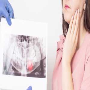 Wisdom Tooth Removal In Goregaon: A Complete Guide