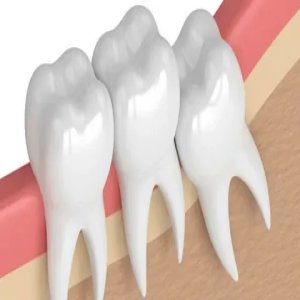 Wisdom Tooth Removal: What Happens To Extracted Teeth?