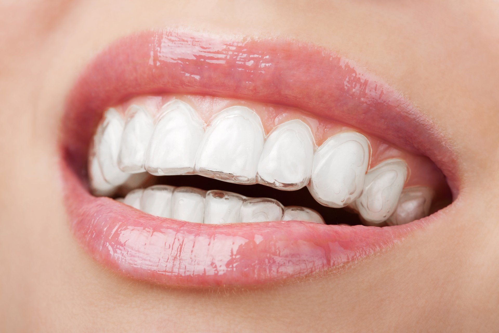 Straightening and Teeth Braces