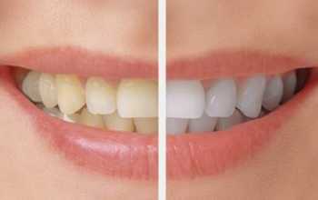 Teeth Whitening Treatment In Nagpur