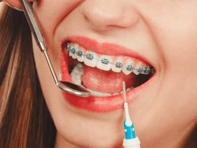 The Benefits Of Teeth Cleaning For People With Braces