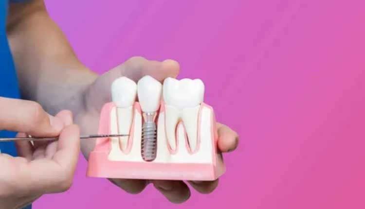 The Comprehensive Guide To Full Mouth Implant Cost In Nerul