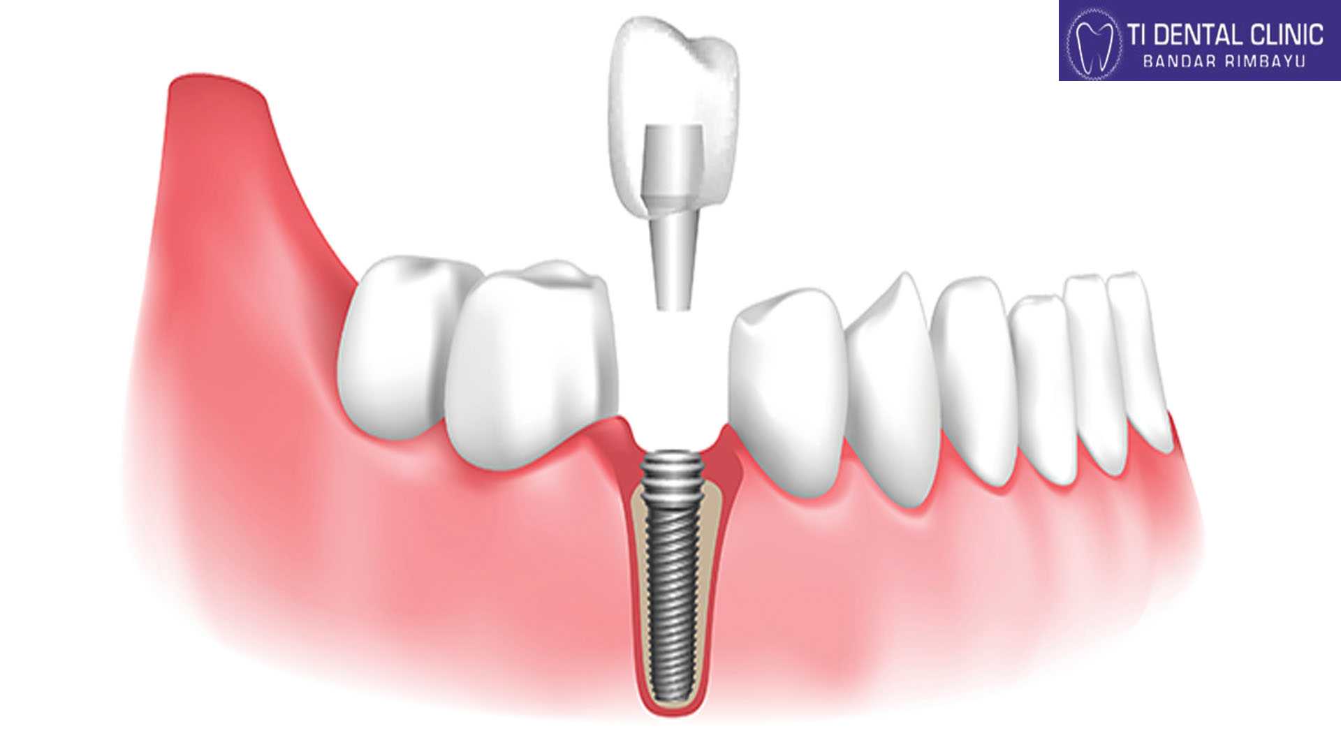 The Investment In Your Smile: Factors Affecting Dental Implants Cost