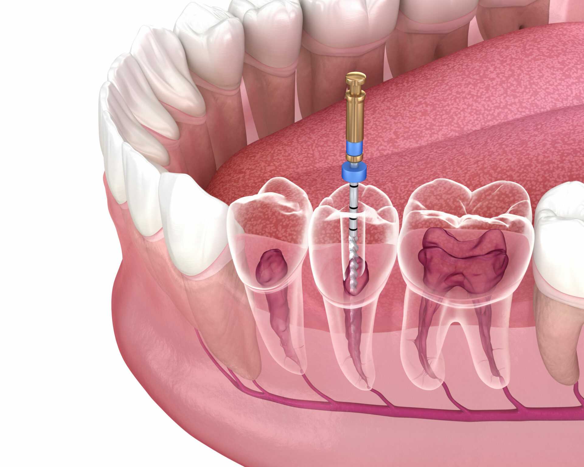 Tooth Root Canal: A Comprehensive Guide To Treatment And Recovery