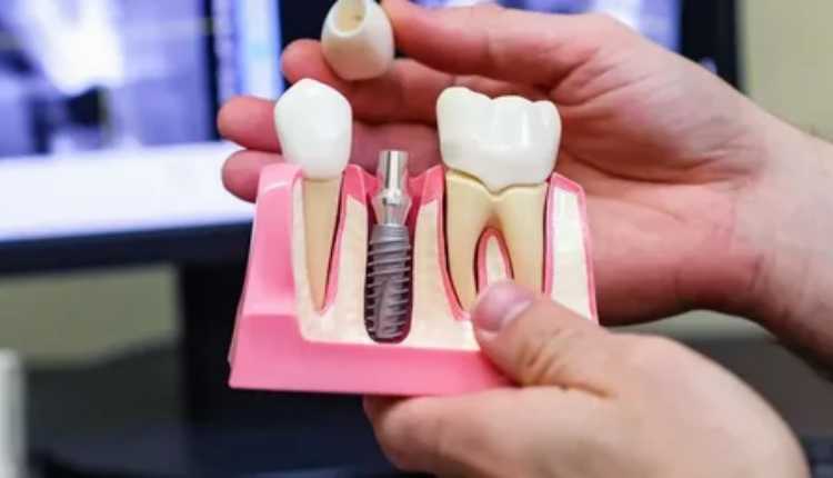 Unveiling Excellence: Dental Implant Treatment In Nizamabad