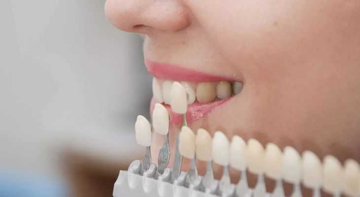 What Happens To Teeth Under Veneers? – Understanding The Truth Behind The Smile