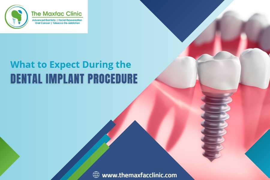 What To Expect During The Dental Implant Procedure